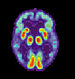 Brain with Alzheimers.jpg